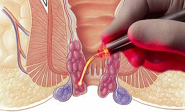Best Laser surgery Rewa